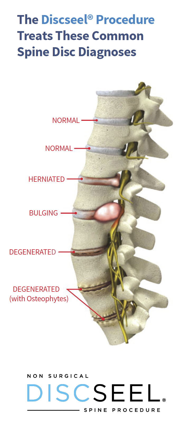 discseel procedure for spine